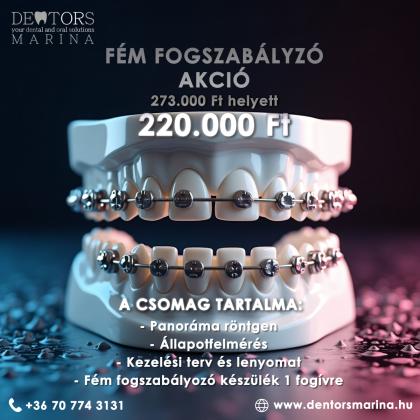 Fém Fogszabályozó Akció Fém Fogszabályozó Akció