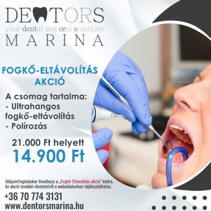 Fogkő Eltávolítás AKCIÓ